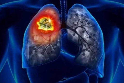 Anvisa avalia novo tratamento para câncer de pulmão