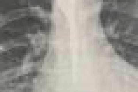 Com garfo no corpo, mulher é internada em hospital após engolir utensílio durante refeição na Bahia